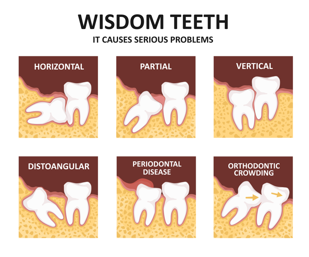 Wisdom Teeth Removal Cost in Delhi