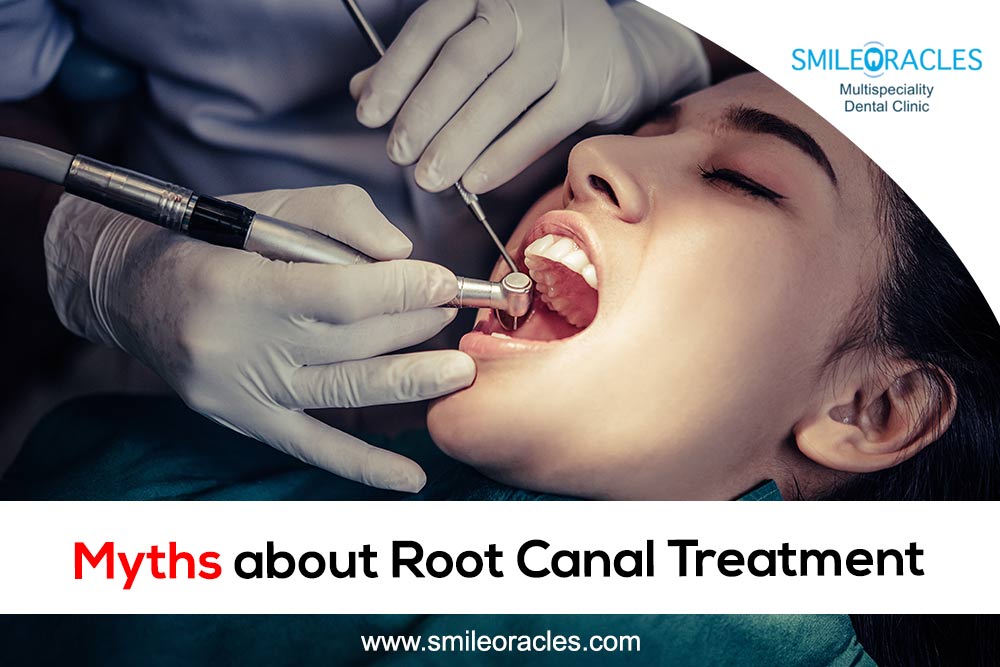 Myths About Root Canal Treatment