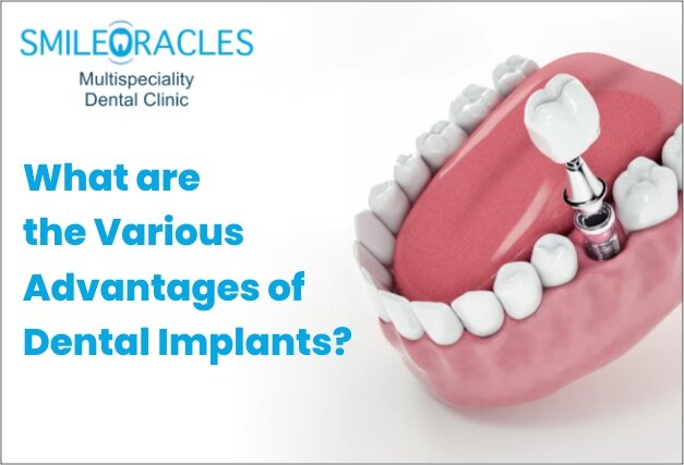 Advantages of Dental Implants